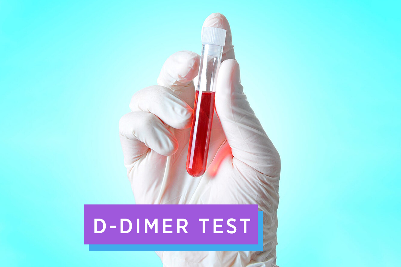 dimer test